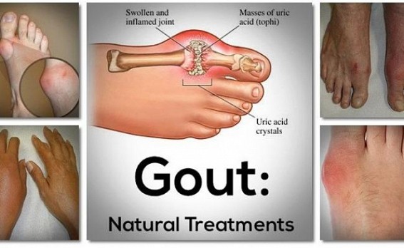Get even with gout 