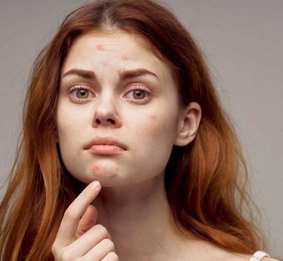 Poor dietary habits, increased stress linked with acne Poor dietary habits, increased stress linked with acne