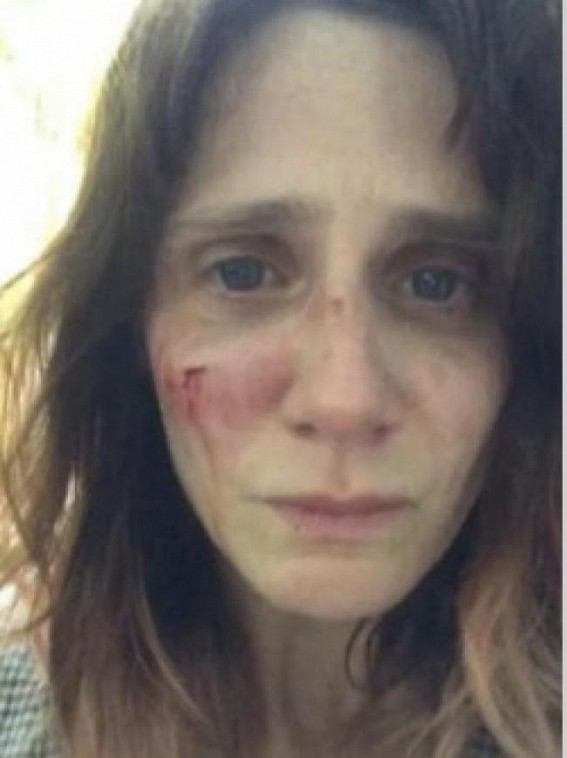 Victim of domestic abuse, French actress posts shocking pics on Instagram Victim of domestic abuse, French actress posts shocking pics on Instagram