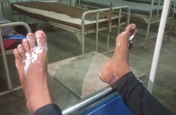 School Students were admitted to Gomati District Hospital after their feet were burnt while performing on I-Day : No Govt Official visited Hospital : Doctor reports Stable Health of Children