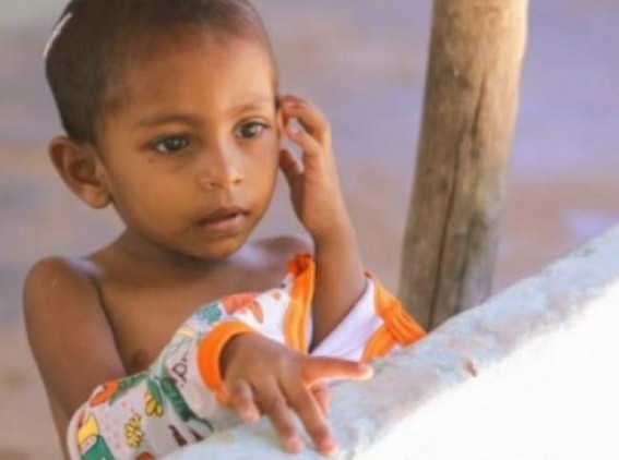Malnutrition rises among Sri Lankan kids under 5: Health Minister