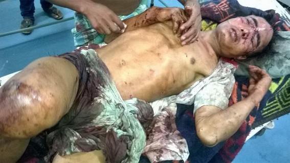 Santirbazar : Wild Bear critically mauls villager; battling for life in Gomati Dist Hospital Santirbazar : Wild Bear critically mauls villager; battling for life in Gomati Dist Hospital