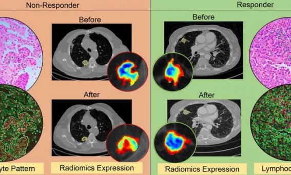 AI to determine if immunotherapy is working in lung cancer