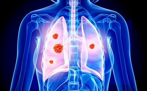 Northeastern states experience higher burden of cancers: ICMR Northeastern states experience higher burden of cancers: ICMR